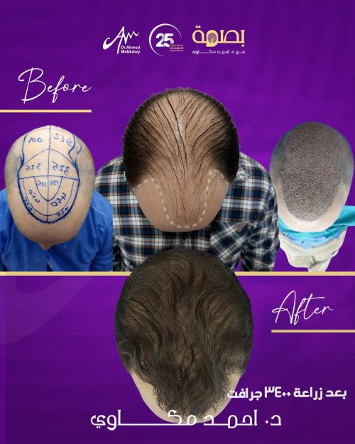 زراعة الشعر مع ضعف المنطقة المانحة